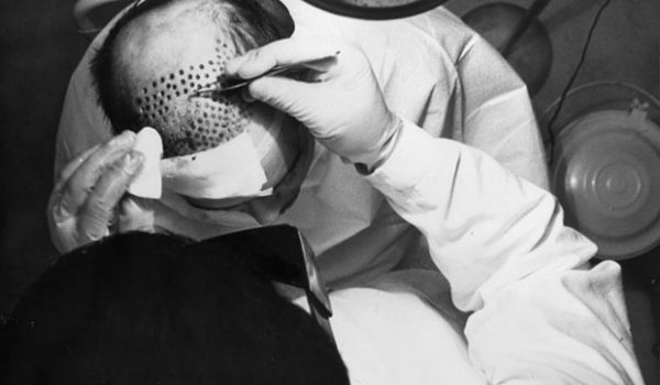 Historia transplantacji włosów