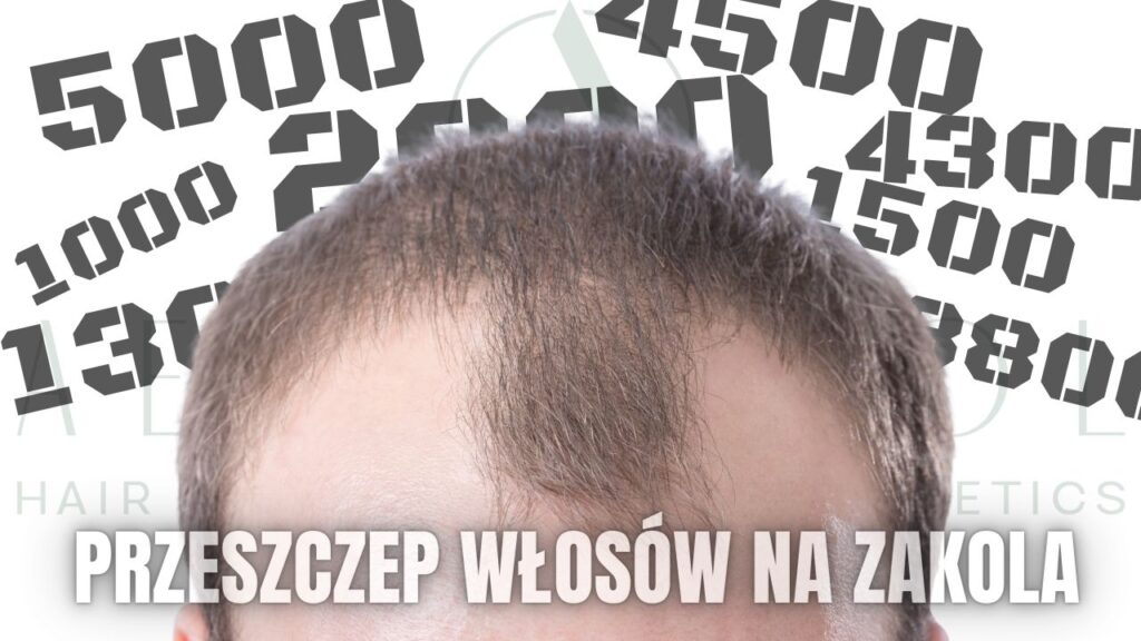 przeszczep włosów zakola