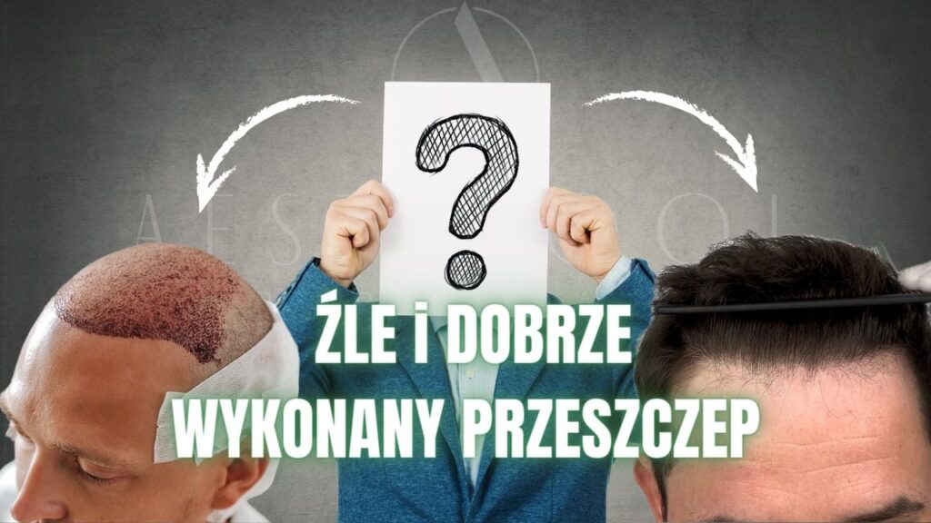 dobry przeszczep włosów w Turcji