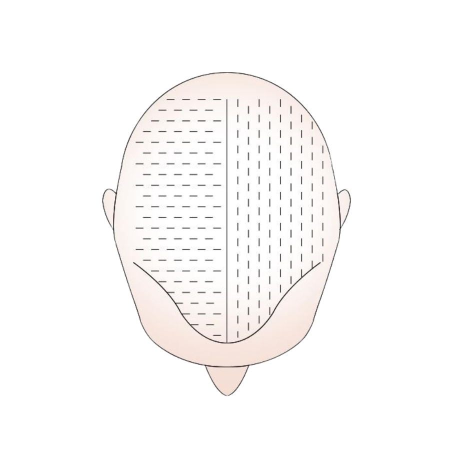 Micro FUE - Dr Ahtan Altan - Przeszczep włosów - Aestepool Clinic